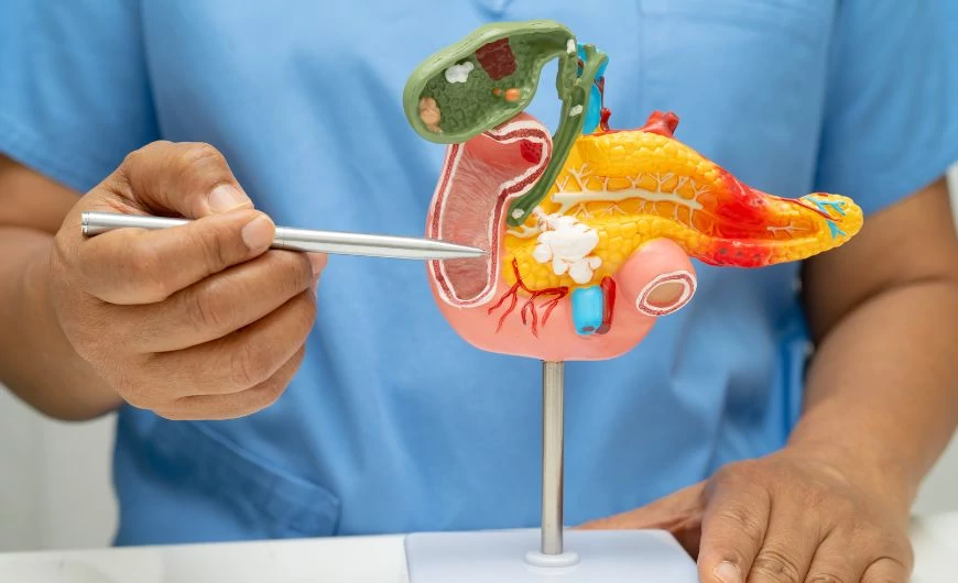 Gyógynövények szerepe az epekövek oldásában és méretének csökkentésében